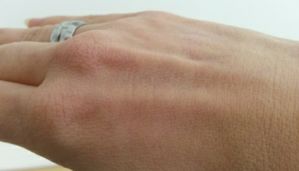 Hřbet ruky před natřením mastí Epaderm (pro zvětšení klikněte na obrázek)